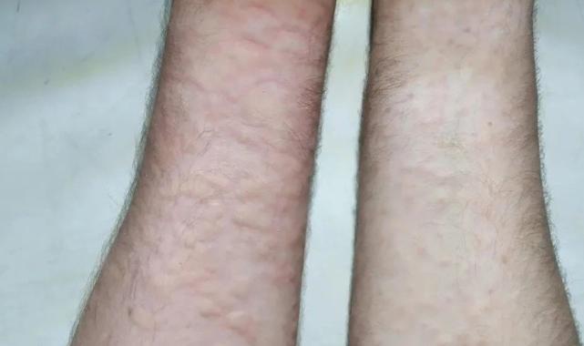 ABD'de kanını sivrisineklere veren adam şaşkına çevirdi