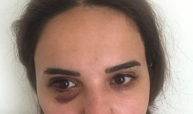 Iğdır'da boşanmak istediği eşinden dayak yedi: Mağdur eş adalet için yardım istedi