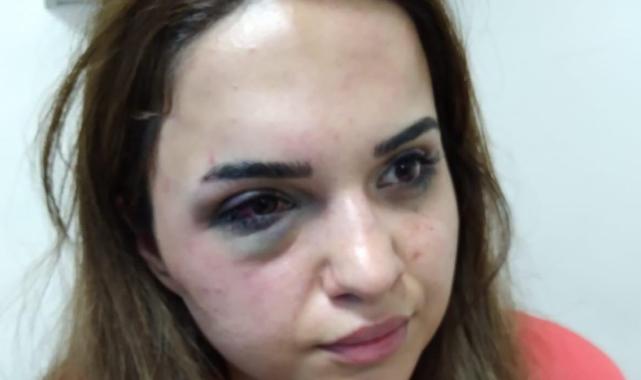 Iğdır'da boşanmak istediği eşinden dayak yedi: Mağdur eş adalet için yardım istedi