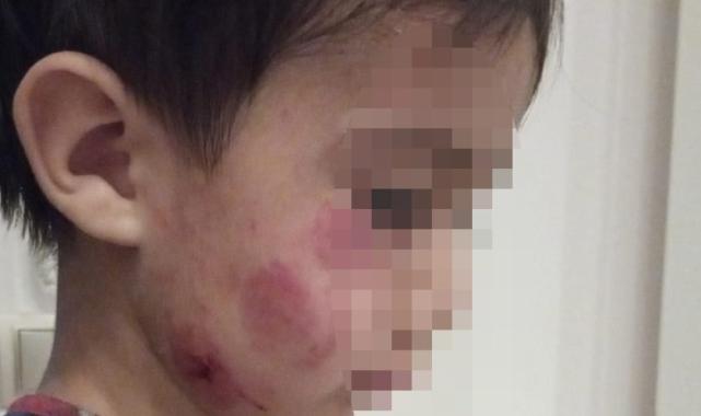Konya'da anaokulunda akılalmaz olay: Uyurken 13 yerinden ısırdı