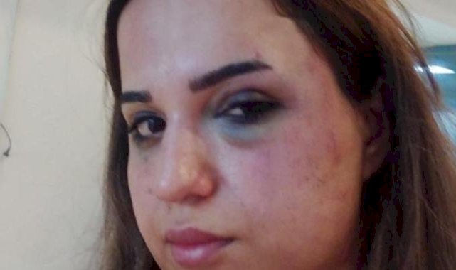 Iğdır'da boşanmak istediği eşinden dayak yedi: Mağdur eş adalet için yardım istedi