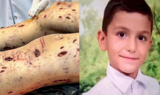 Köpeklerin saldırdığı Tunahan'ın acı dolu tedavi süreci