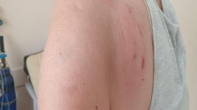 Antalya'da iki kadın besledikleri kedinin saldırısına uğradı