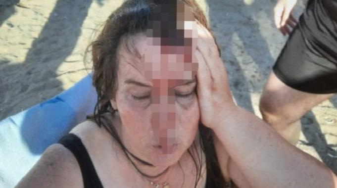 Denizde yüzerken jet ski çarptı, ölümden döndü