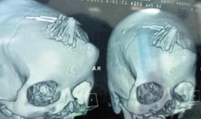 Hindistan'da baş ağrısı şikayetiyle gitti: Kafatasından 77 iğne çıkarıldı