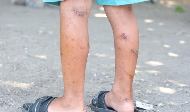 Köpeklerin saldırdığı çocuk taburcu oldu