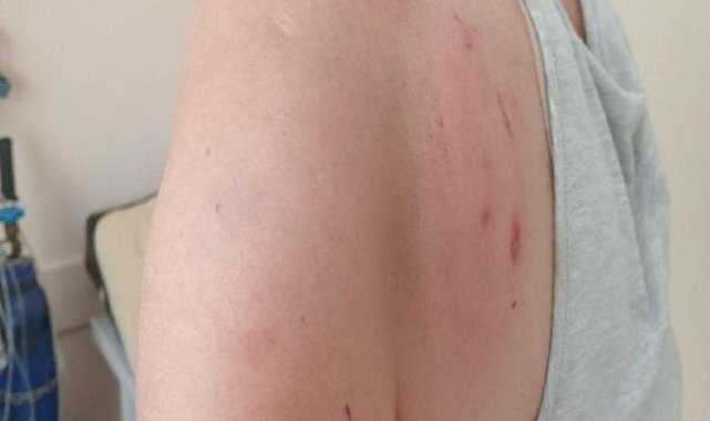 Antalya'da iki kadın besledikleri kedinin saldırısına uğradı