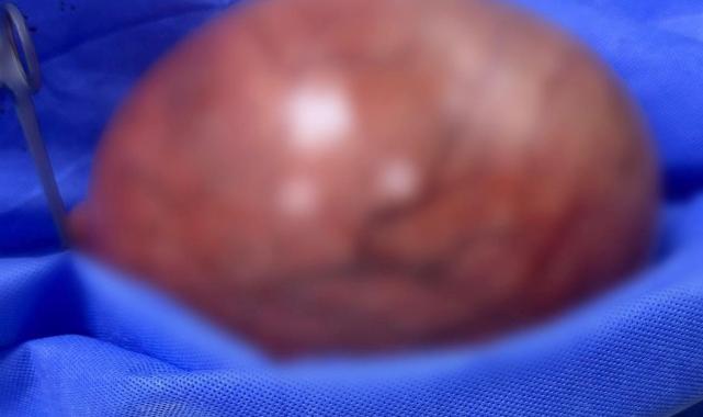 Trabzon'da karın ağrısı şikayetiyle gitti, 5.5 kg kitle çıktı