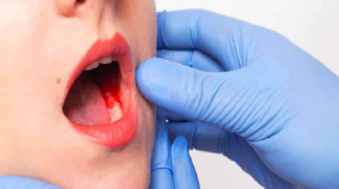 Ağız Kokusu Neden Olur?