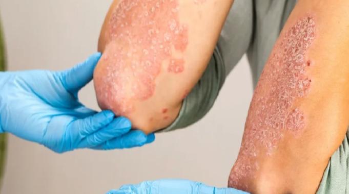 Bursa&#039;da mantar uyarısı