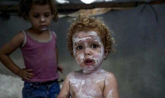 Gazze'de cilt hastalıkları çocuklar arasında yayılıyor