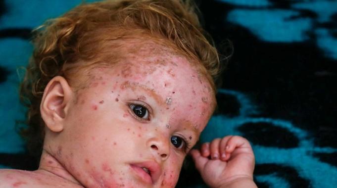 Gazze'de cilt hastalıkları çocuklar arasında yayılıyor