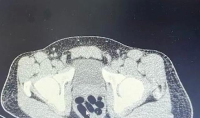 Kayseri'de şüphelinin midesinden 1 kilo uyuşturucu çıktı