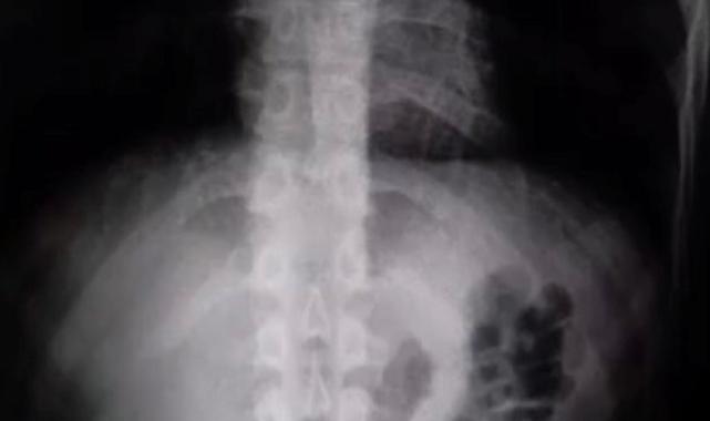 Kayseri'de şüphelinin midesinden 1 kilo uyuşturucu çıktı