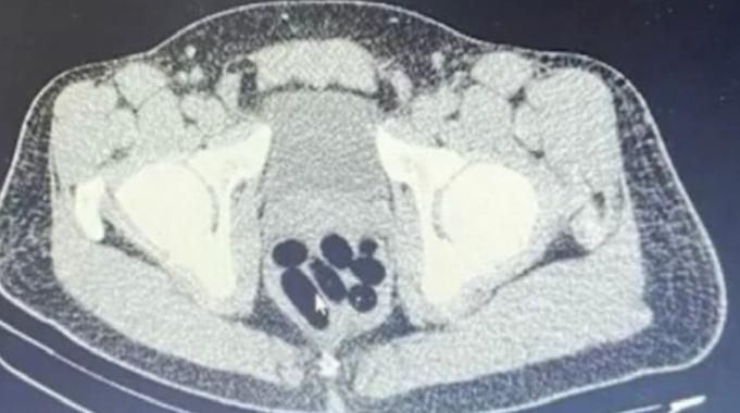 Kayseri&#039;de şüphelinin midesinden 1 kilo uyuşturucu çıktı
