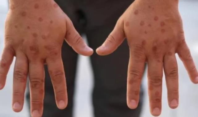 Maymun çiçeği virüsü hakkında bilinen yanlışlar