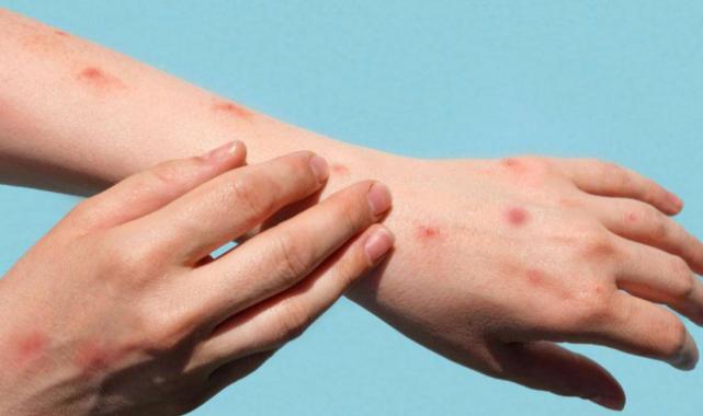 Maymun çiçeği virüsü hakkında bilinen yanlışlar