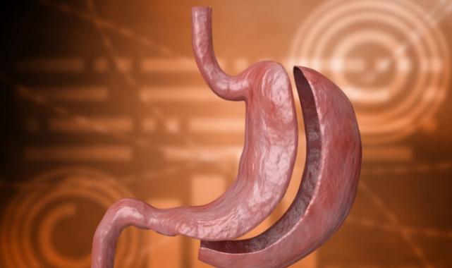 Mide küçültme ameliyatlarındaki ölüm vakaları artıyor
