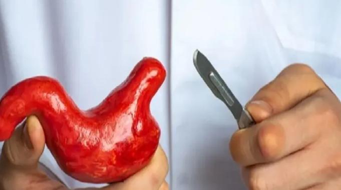 Mide küçültme ameliyatlarındaki ölüm vakaları artıyor