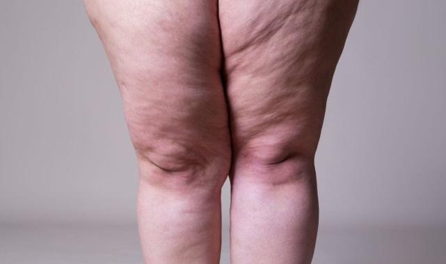 Selülit gibi görünen "lipödem" nedir, nasıl anlaşılır?