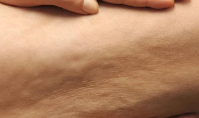Selülit gibi görünen "lipödem" nedir, nasıl anlaşılır?