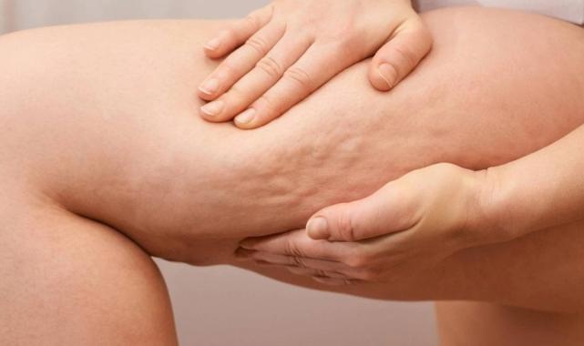 Selülit gibi görünen "lipödem" nedir, nasıl anlaşılır?