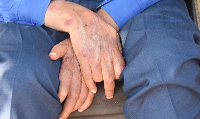 Sivas'ta yüzde 100 engelli hasta, bakımevlerine alınmıyor