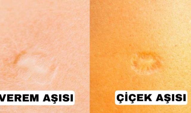Sol omuzdaki aşı izi verem mi, çiçek mi? Çiçek aşısı izi nasıl olur? İşte örneği