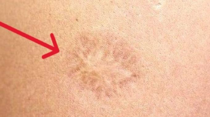 Sol omuzdaki aşı izi verem mi, çiçek mi? Çiçek aşısı izi nasıl olur? İşte örneği