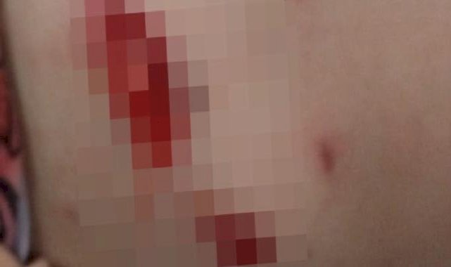 Ankara'da başıboş köpekler, 5 yaşındaki kıza saldırdı