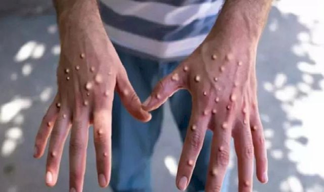 Sağlık Bakanlığı açıkladı: İşte 11 soruda maymun çiçeğiyle ilgili merak edilenler...