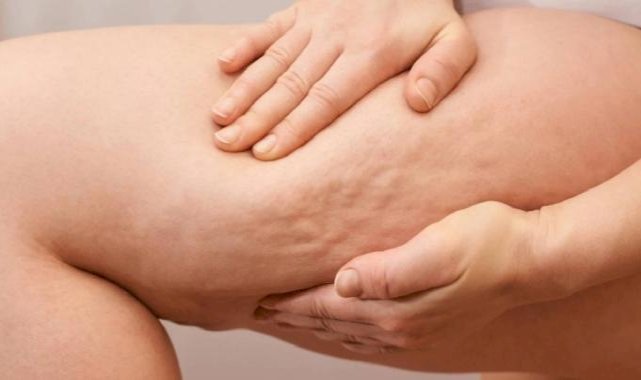 Selülit gibi görünen "lipödem" nedir, nasıl anlaşılır?