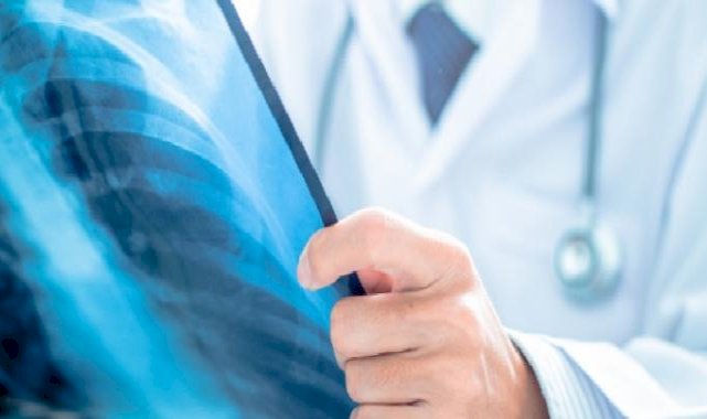 Türkiye’de 2023’te 41 bin Kişiye Akciğer Kanseri Tanısı Kondu