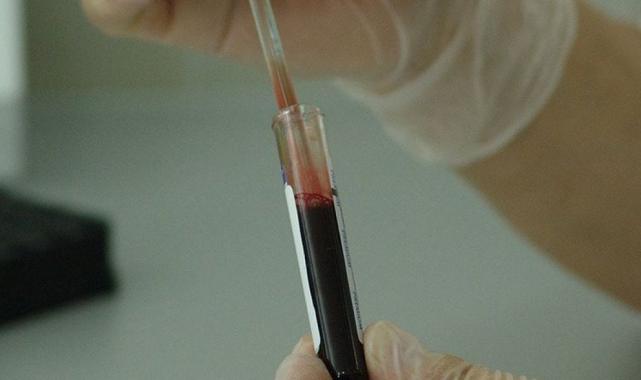 13 Eylül Dünya Sepsis Günü