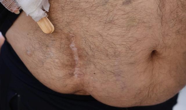 Adana'da eşine verdiği böbrek başka hastaya takıldı: Çapraz nakile zorlandı