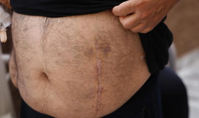 Adana'da eşine verdiği böbrek başka hastaya takıldı: Çapraz nakile zorlandı