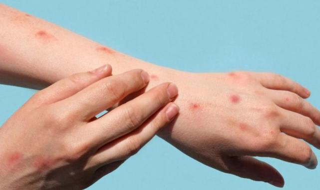 DSÖ: Afrika’da bu yıl içinde 30 bin şüpheli M-çiçeği virüsü vakası görüldü