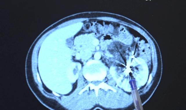 İzmir'de fıtık için hastaneye gitti: Tek böbrekli olduğunu öğrendi