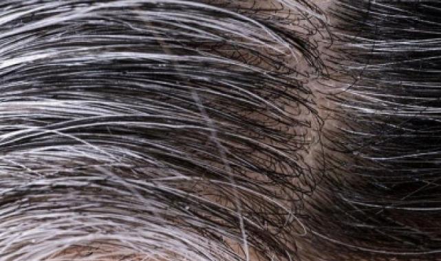 Saç neden beyazlar? İşte 6 nedeni!