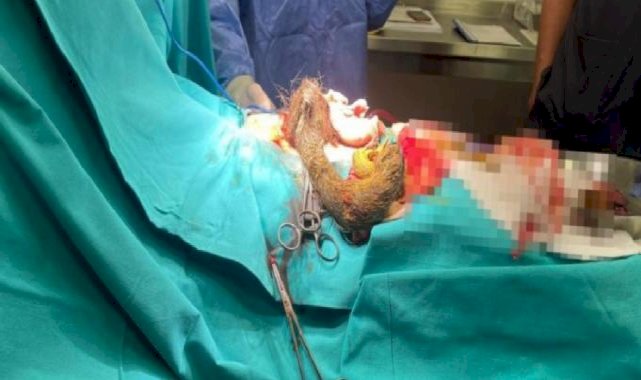 Kayseri'de şaşırtan olay: 14 yaşındaki kızın midesinden 3.5 kilo saç kılı çıktı