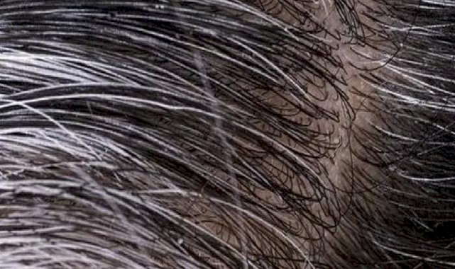 Saç neden beyazlar? İşte 6 nedeni!