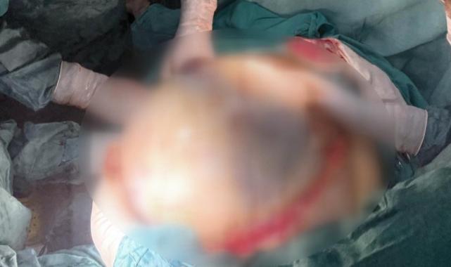 Yalova'da doktorları şaşırtan vaka: Yumurtalıklarından 23 kilo tümör çıktı