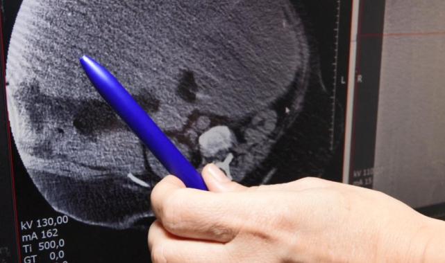 Yalova'da doktorları şaşırtan vaka: Yumurtalıklarından 23 kilo tümör çıktı