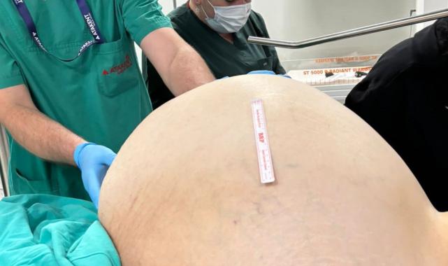 Yalova'da doktorları şaşırtan vaka: Yumurtalıklarından 23 kilo tümör çıktı