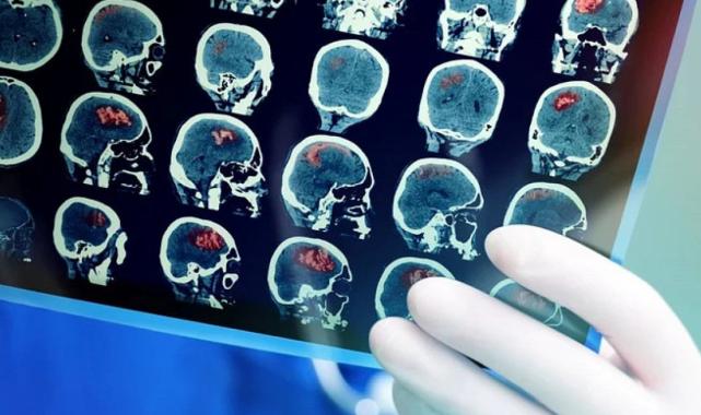 Aziz Sancar'dan 'beyin kanseri' çalışması: 2 yıl boyunca insanlarda denenecek