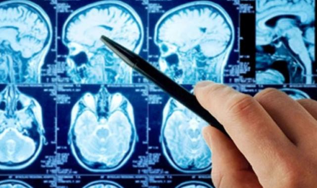 Aziz Sancar'dan 'beyin kanseri' çalışması: 2 yıl boyunca insanlarda denenecek