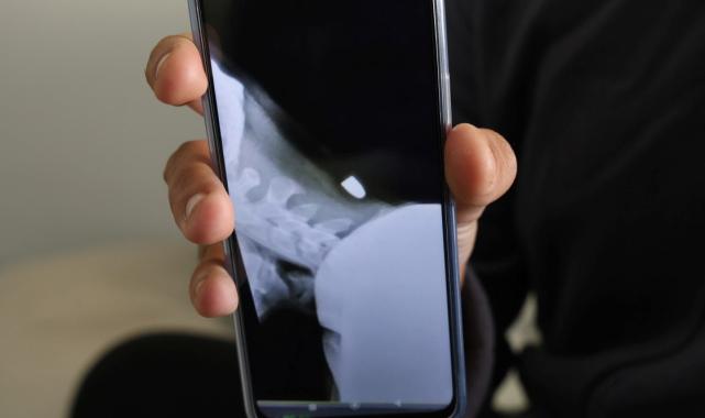 Hatay'da boynuna yorgun mermi saplandı: Kıl payı ölümden döndü