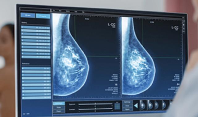 “Mamografi erken tanı ve tedavi için önemli”