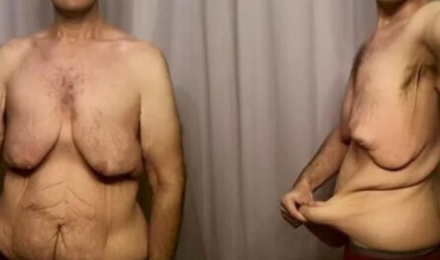 Obezite ameliyatlarından sonra oluşan deri sarkması tedavi edilebilir mi?