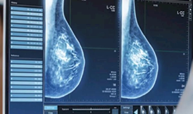 “Mamografi erken tanı ve tedavi için önemli”